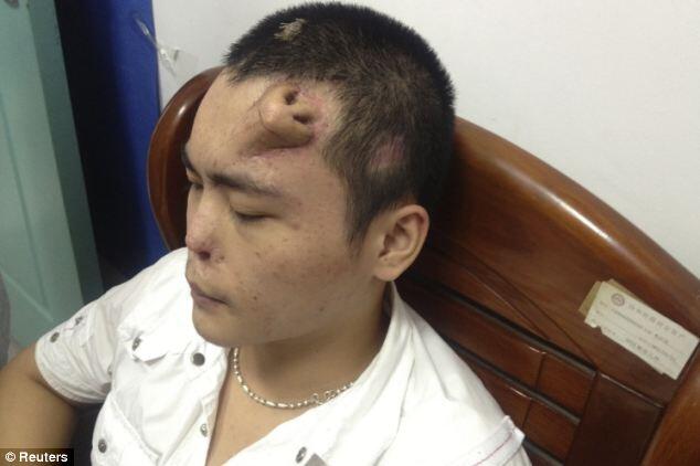 Hidung Baru `Tumbuh` di Dahi Pria China