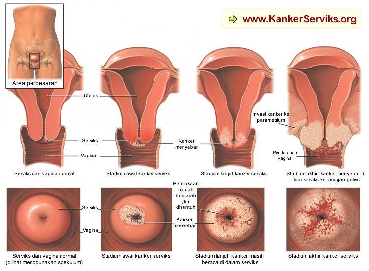 Kanker Serviks Pembunuh Pertama Wanita Indonesia