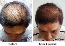 (Ask) Klinik Hair Transplant di Jakarta