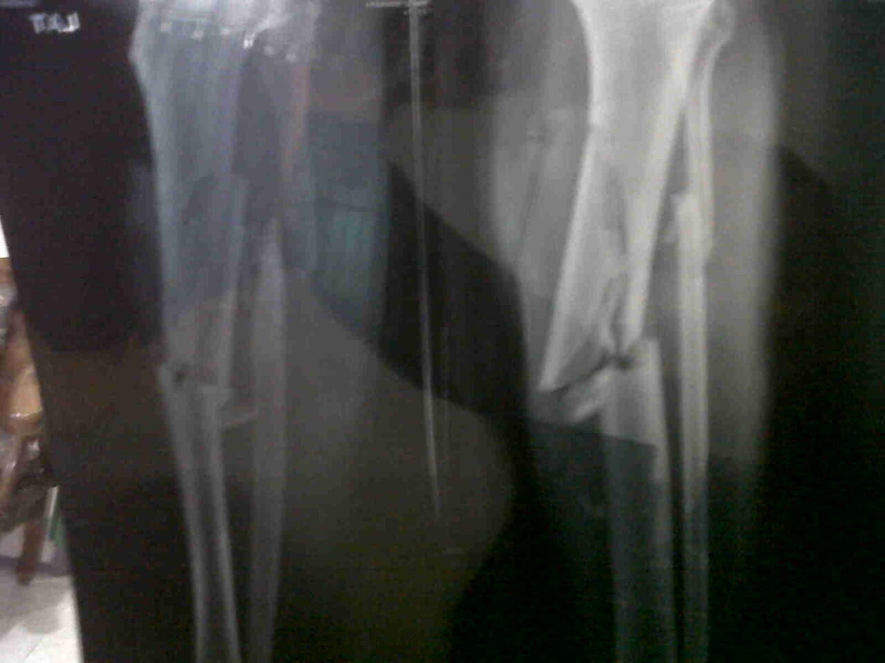 Ts korban tabrak lari ( ASLI ) ijin curhat ya momon mimin