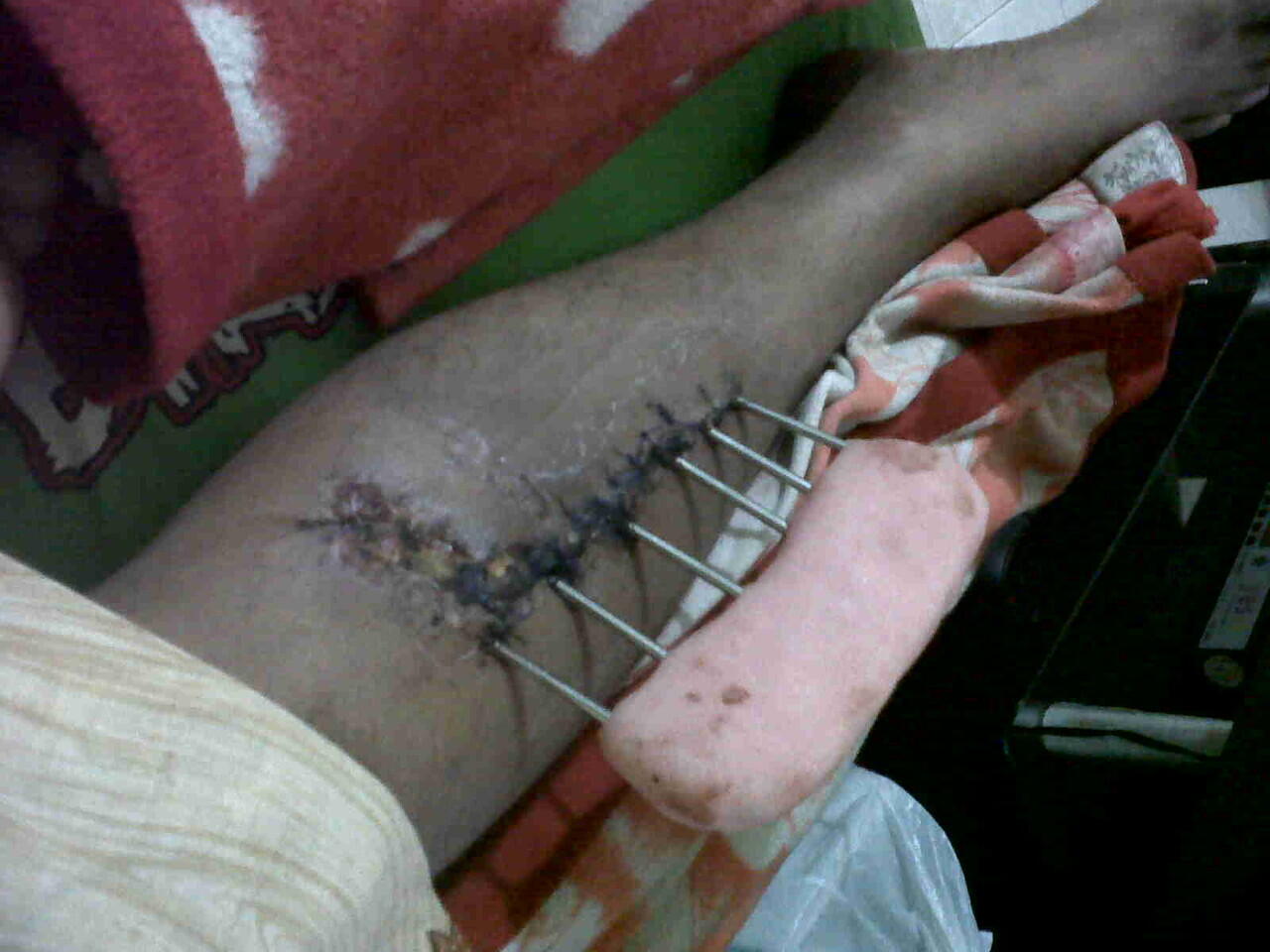 Ts korban tabrak lari ( ASLI ) ijin curhat ya momon mimin