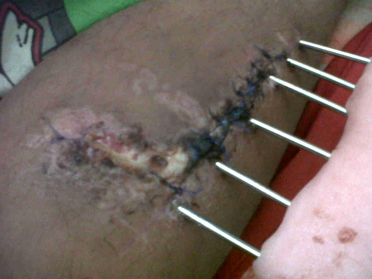 Ts korban tabrak lari ( ASLI ) ijin curhat ya momon mimin