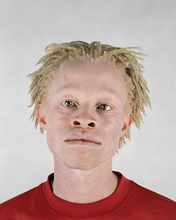 Foto - foto Orang Albino Afrika
