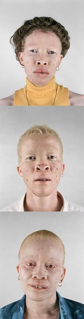 Foto - foto Orang Albino Afrika