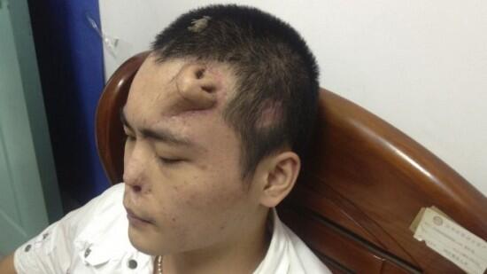 Orang dengan Hidung di Jidatnya !!!