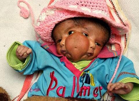 Bayi Berkepala 2 dan Bermata 4 di India