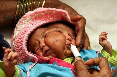 Bayi Berkepala 2 dan Bermata 4 di India