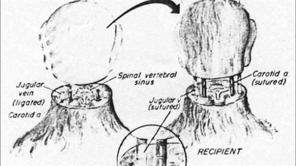 Dengan Fusogen, Kepala Manusia Bisa Dipindahkan Ke Tubuh Lain