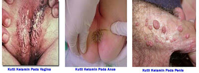 WTS: HERBAL : OBAT KANKER Dan OBAT KUTIL KELAMIN