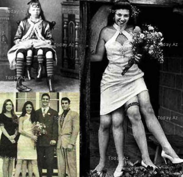 Josephine Myrtle Corbin, manusia berkaki 4