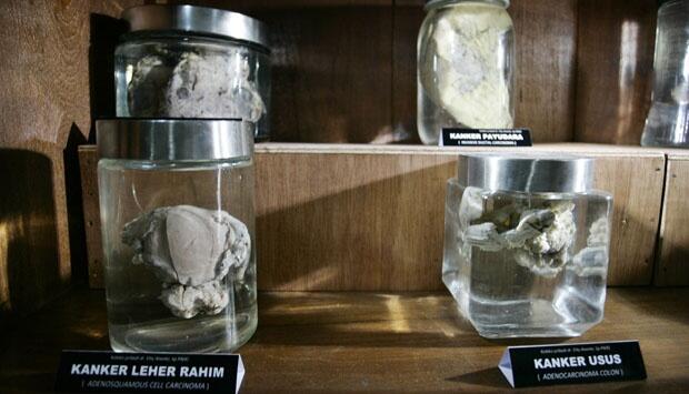 Museum Kanker Pertama di Indonesia Resmi Dibuka