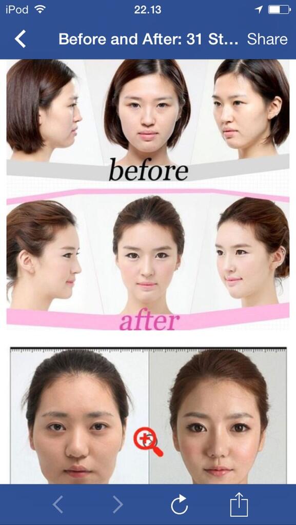 (Before and After) Keajaiban Operasi plastik Korea