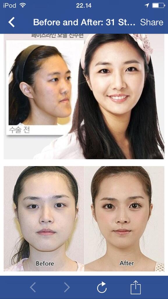 (Before and After) Keajaiban Operasi plastik Korea