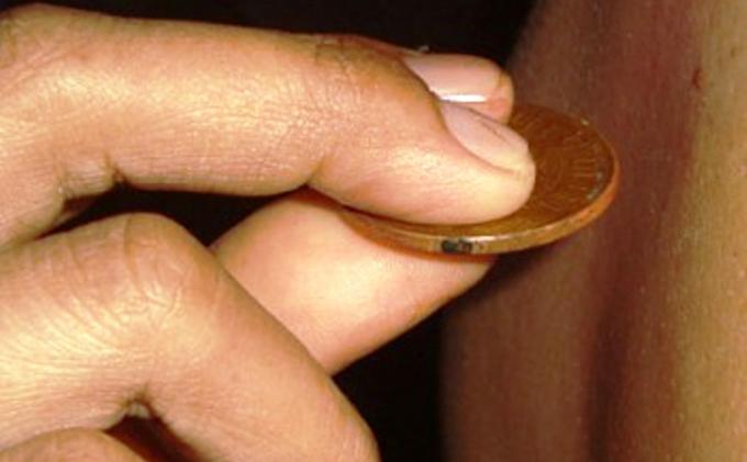 Masuk Angin Boleh Dikerok, Asal Pakai Teknik Yang Benar
