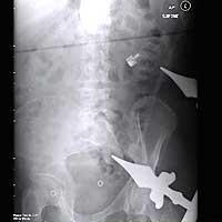 Hasil Foto X-Ray Paling Mengerikan di Dunia