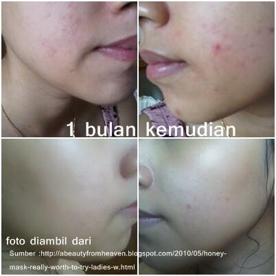 &#91;SHARE&#93; Cara ane ngatasin JERAWAT, sabar, mudah dan hemat !! 