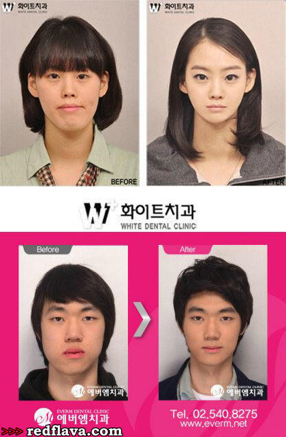 Kumpulan Foto Before - After orang Korea gan (gile banget perbedaannya)