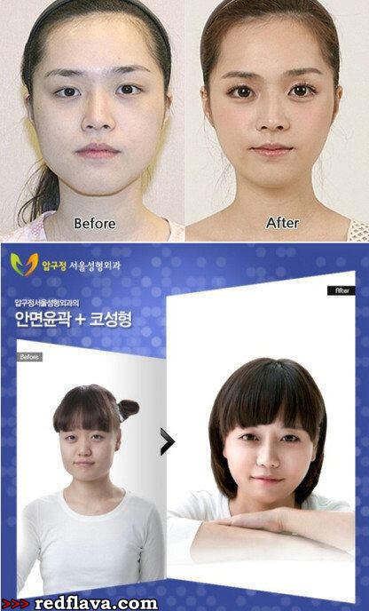 Kumpulan Foto Before - After orang Korea gan (gile banget perbedaannya)
