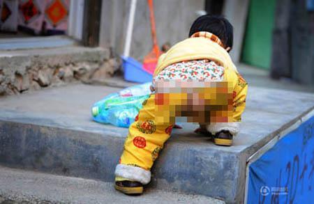 Balita 2 Tahun Kumpulkan Botol Bekas untuk Biaya Operasi Jantung