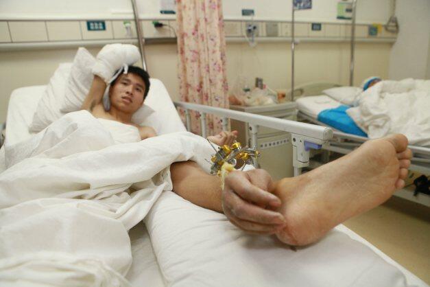 &#91;Dokter anti-mainstream&#93; menyelamatkan tangan yg terputus dengan cangkok pada betis
