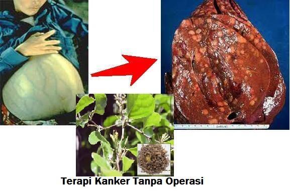 6 KESALAHAN PIKIR DALAM PENGOBATAN KANKER DENGAN HERBAL