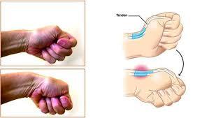 Mengenal Syndrome De Quervain (Yang hoby sport masuk!!)