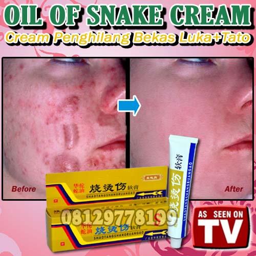 OIL OF SNAKE CREAM (Penghilang Bekas Luka Dan Tato) Pin BB 2A6D5B30
