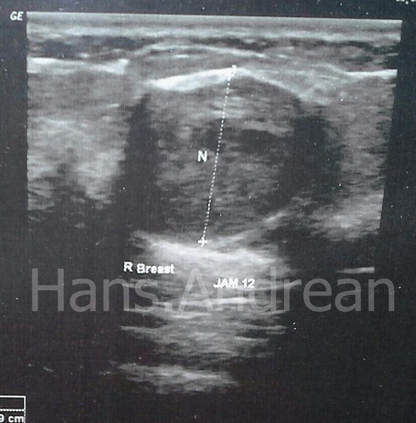 &#91;Kisah Nyata&#93; Untuk Wanita Penderita Tumor Jinak, Masuk!