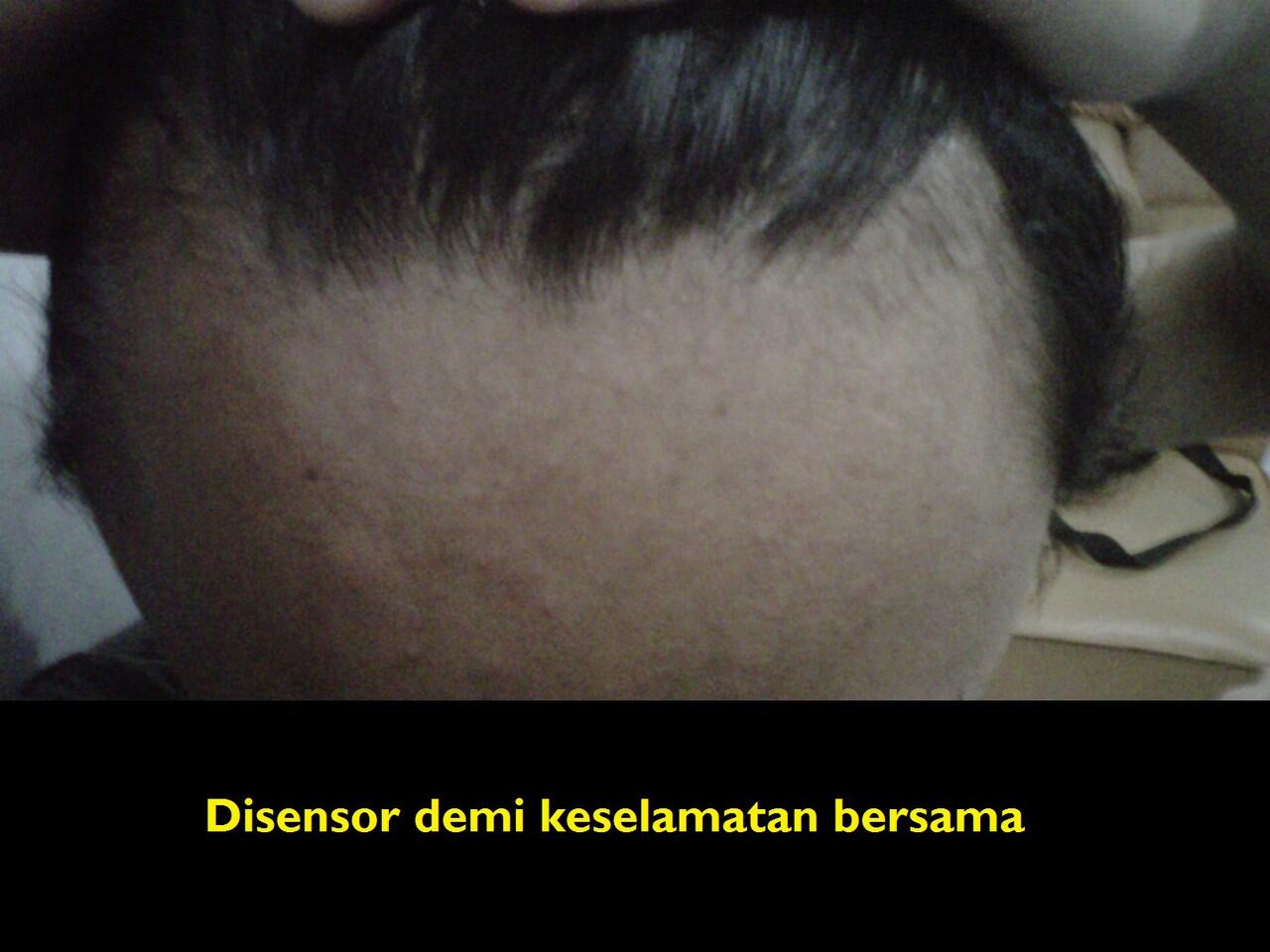 Gimana caranya menumbuhkan rambut di dahi??