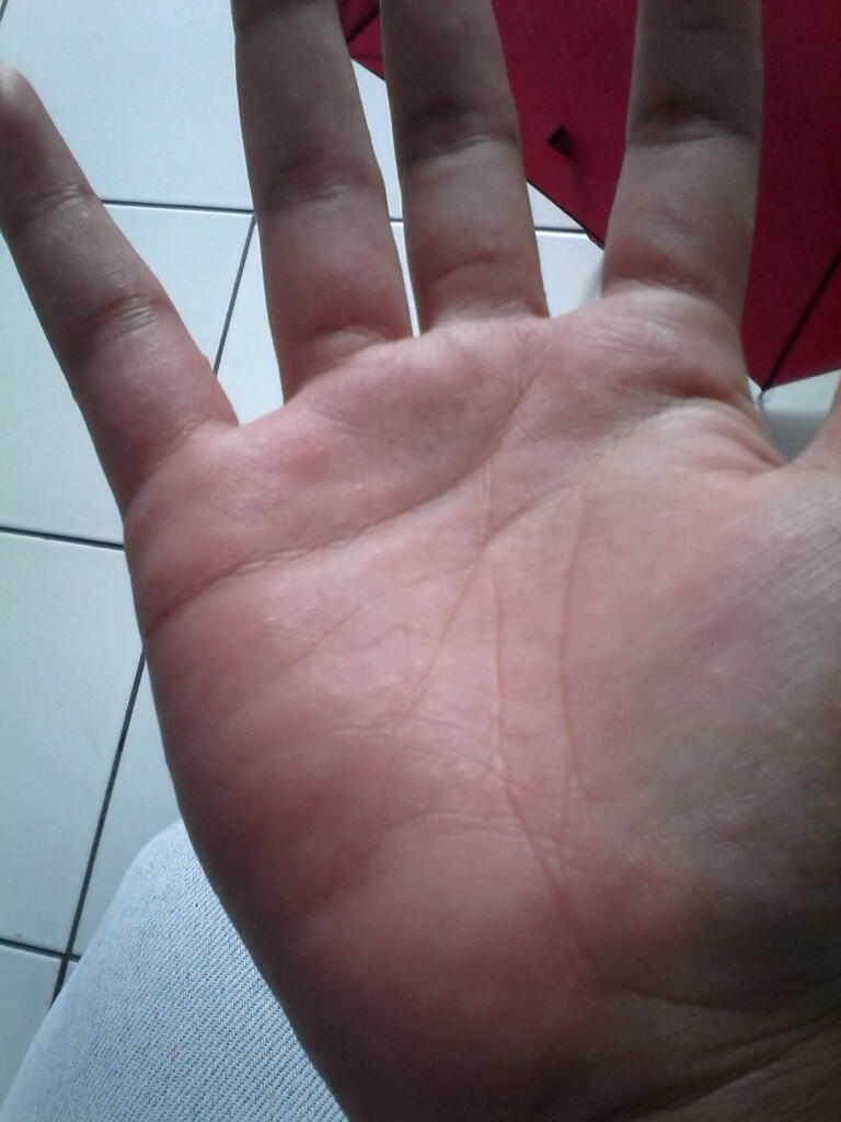 &#91;help&#93; Tangan ma kaki ane bintik2..