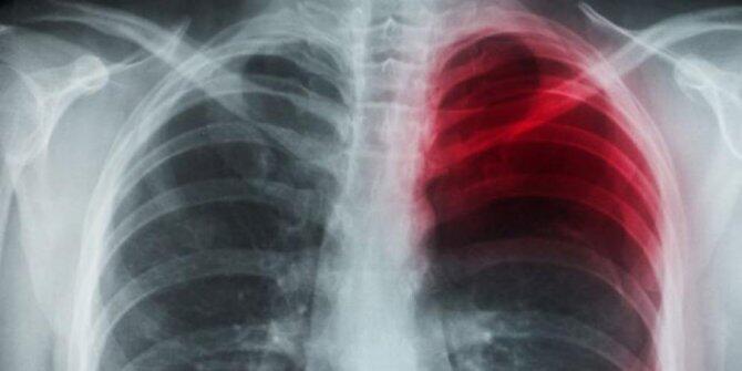 &#91;HATI-HATI&#93; Saat menguap, paru-paru pria China ini robek!