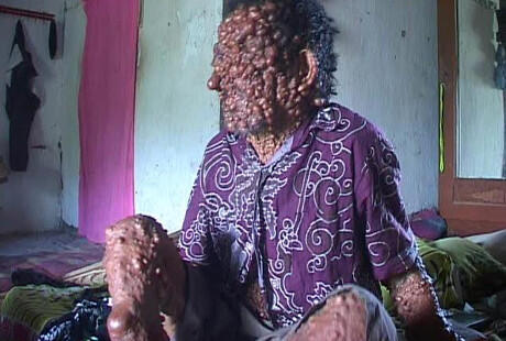 Tumor Makin Banyak, Pria Asal Magetan Ini Hanya Bisa Tergolek di Kasur