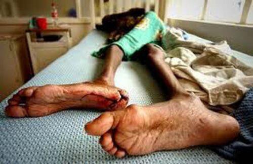 Di temukan di Riau penyakit yang lebih berbahaya dari pada AIDS