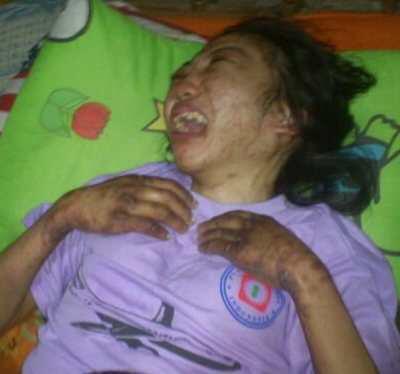 &#91;lagi lagi majikan dari sono&#93; Erwiana, TKW yang Disiksa Majikan Dirawat di RS Sragen 