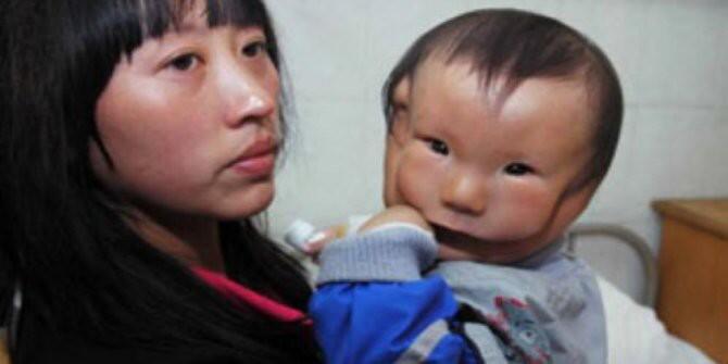 Bayi di China terlahir dengan wajah mirip topeng