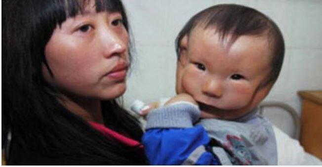 Kasihan, bayi di China terlahir dengan wajah mirip topeng