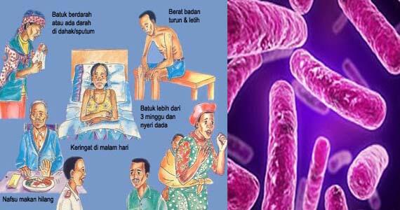 Ciri-ciri (Gejala) Penyebab Penyakit TBC Paru dan Pengobatannya