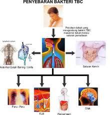 Ciri-ciri (Gejala) Penyebab Penyakit TBC Paru dan Pengobatannya