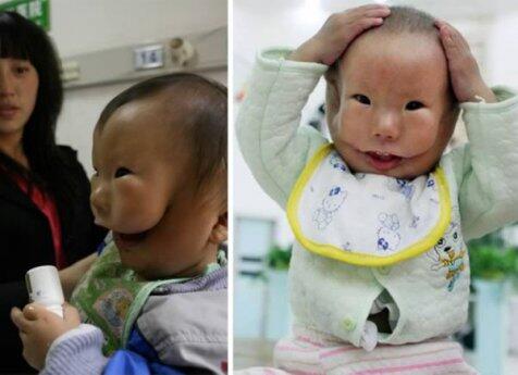 Kasihan, bayi di China terlahir dengan wajah mirip topeng