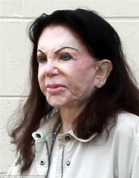 Jackie Stallone, Korban Kecanduan Operasi Plastik