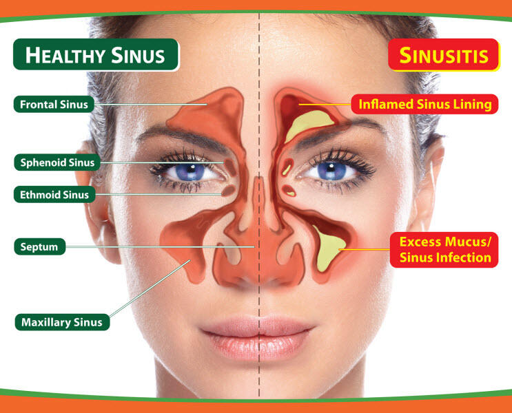 (share) pengalaman ane operasi sinusitis.lumayan serem gan