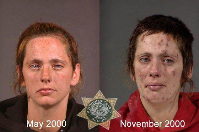 Perubahan Wajah Before &amp; After Menggunakan Narkoba
