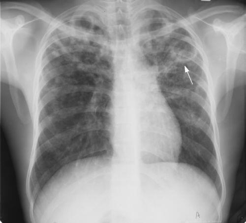 Perlu Banget Memahami Penyakit Tuberculosis Paru (TBC Paru) 