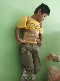 Share..Autis dengan Cerebral Palsy itu beda gan..