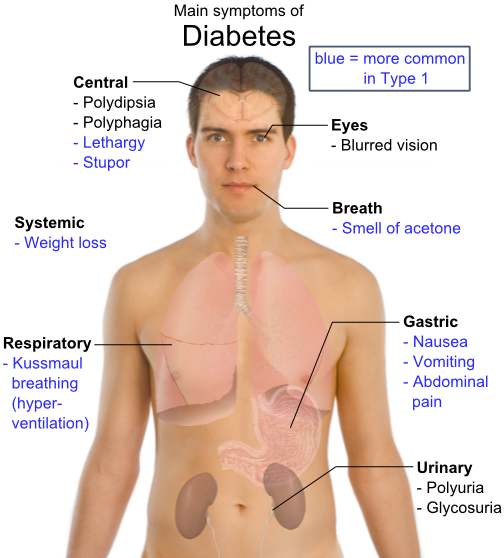 Diabetes, gejala serta cara mengatasinya !