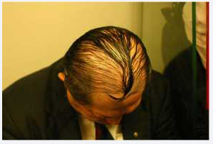 koleksi SISA SISA RAMBUT yang UNIK di kepala yang BOTAK karena RONTOK