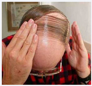 koleksi SISA SISA RAMBUT yang UNIK di kepala yang BOTAK karena RONTOK