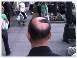 koleksi SISA SISA RAMBUT yang UNIK di kepala yang BOTAK karena RONTOK