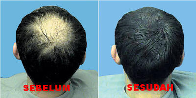 Obat Penumbuh Rambut