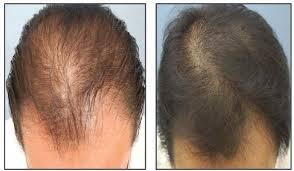 serum green angelica mengatasi kebotakan parah